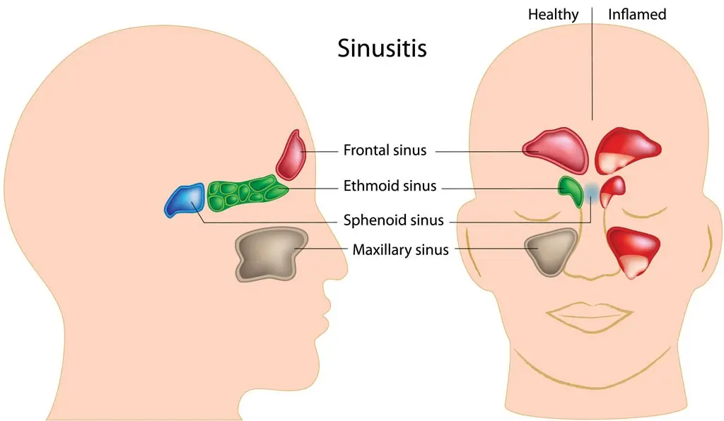 sinusitis